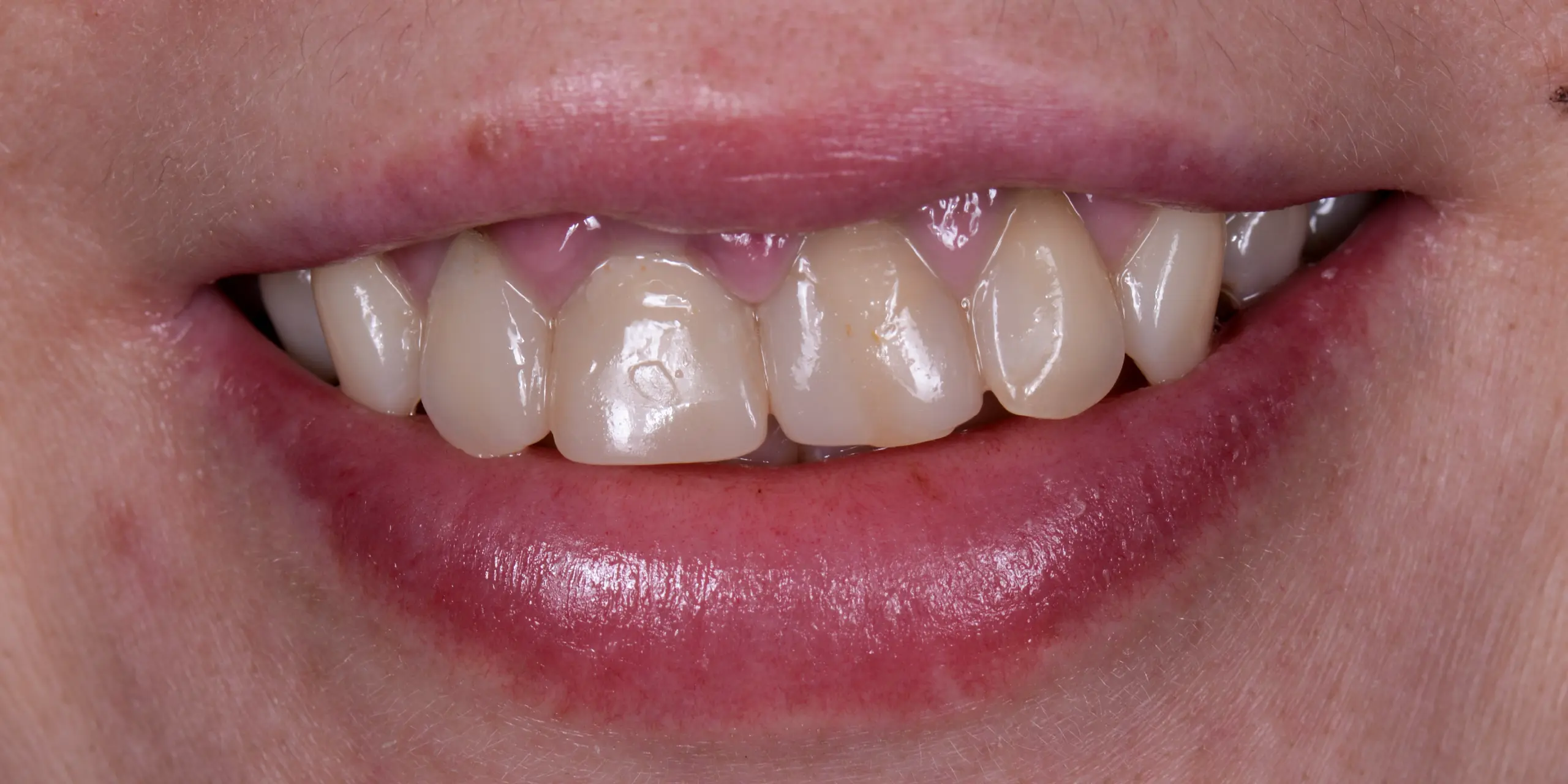 Before — 10 porcelain veneers