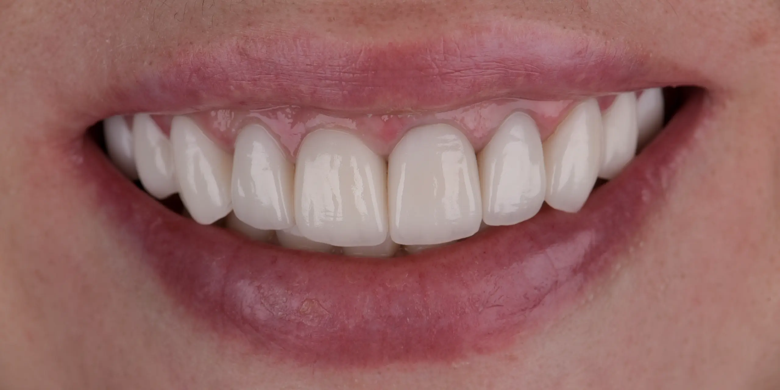 After — 10 porcelain veneers at Dental Veneer Bangkok