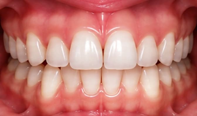 Month 2 — Teeth start to align