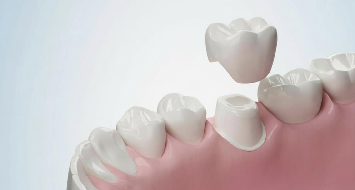Dental Crowns