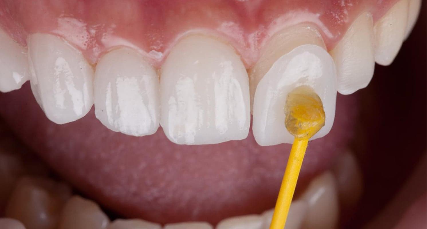Composite Veneers