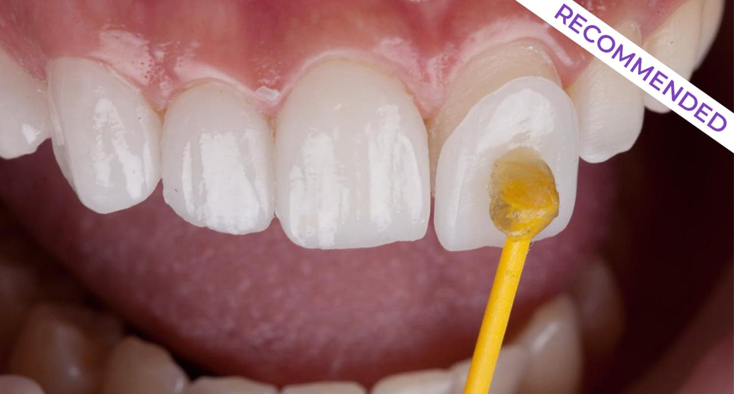 Porcelain Veneers